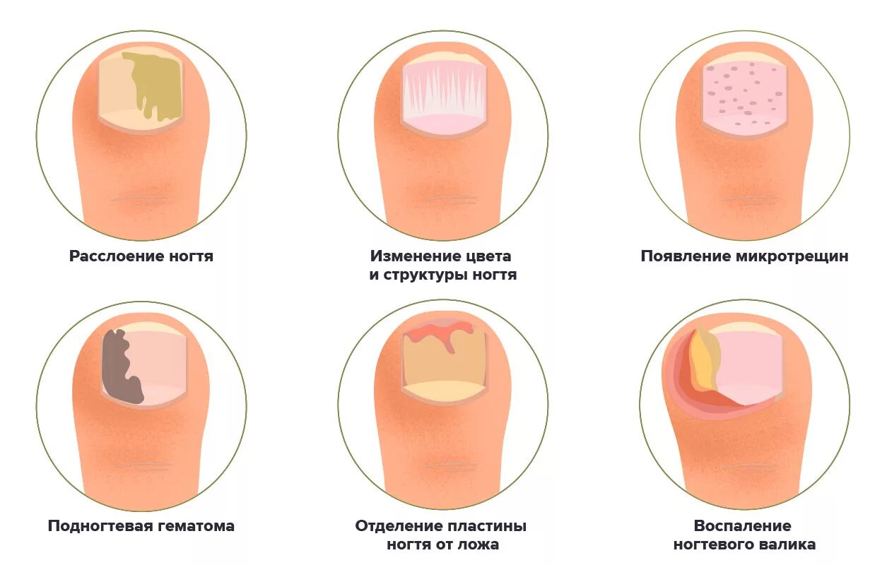 ТРО в составе гель-лаков может вызывать заболевания ногтевой пластины