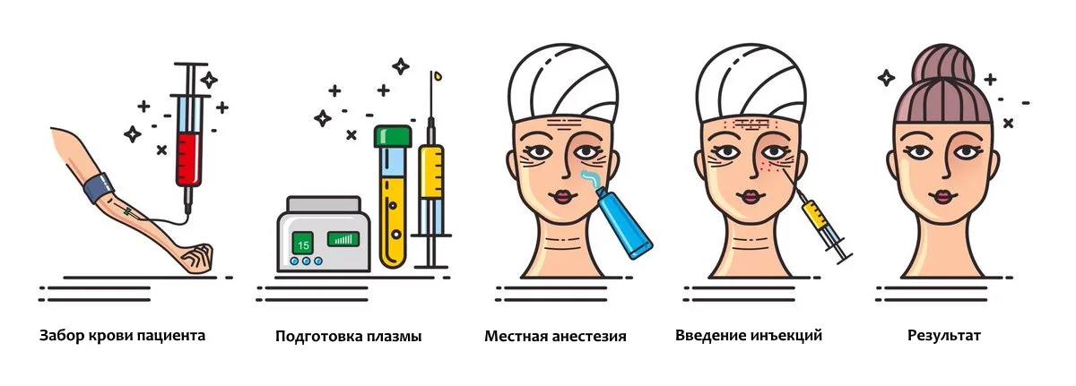 Плазму, богатую тромбоцитами, отделяют и используют для инъекций в проблемные зоны 